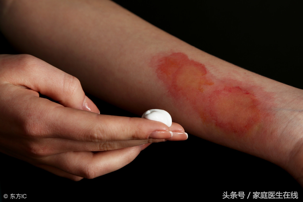 皮肤烫伤怎么办？紧急处理方法学起来，才能不留疤