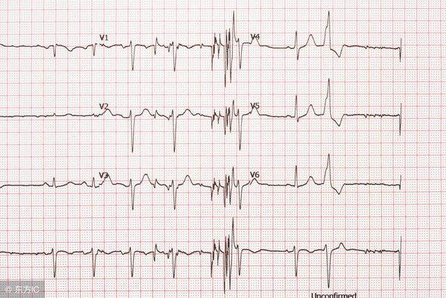 房颤发作时的心电图异常以及预防方法