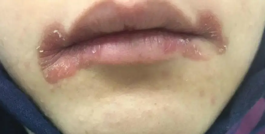 嘴角烂了怎么快速好（嘴角烂是上火的表现吗）