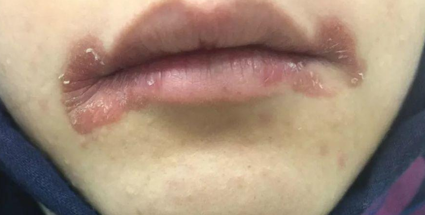 嘴角烂了怎么快速好嘴角烂是上火的表现吗