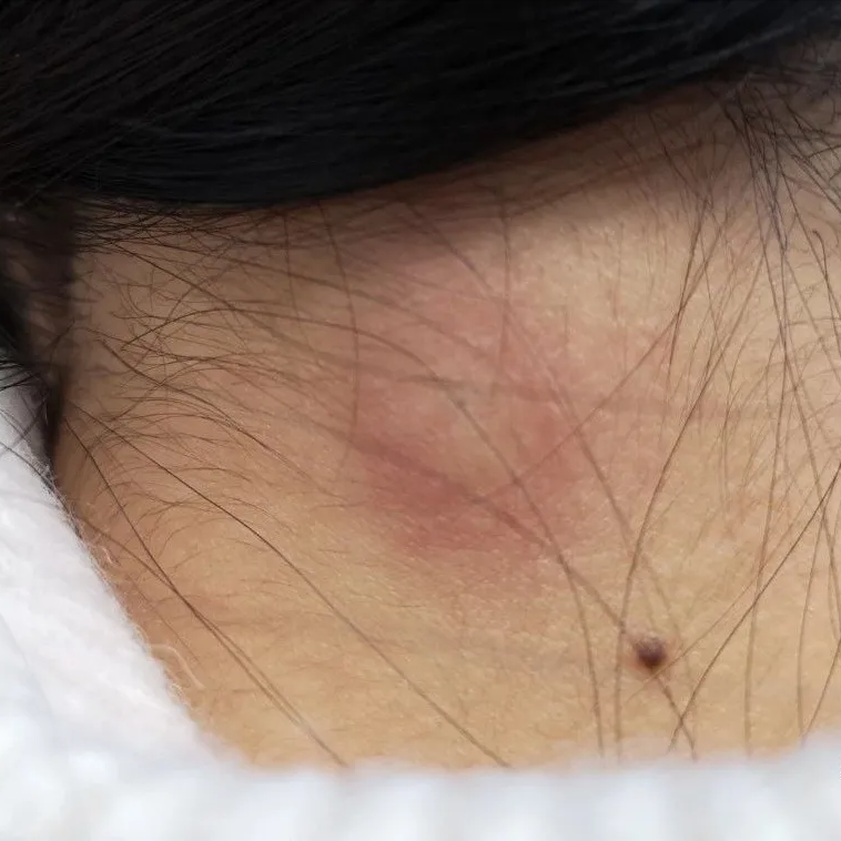 皮脂腺囊肿自愈方法(皮脂腺囊肿挂什么科)-情感知识库-动动脑