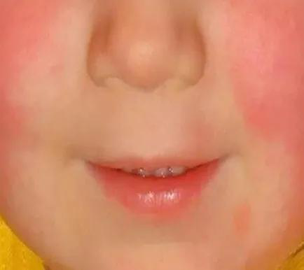 猩红热是什么病症状猩红热身上的鸡皮疙瘩图片