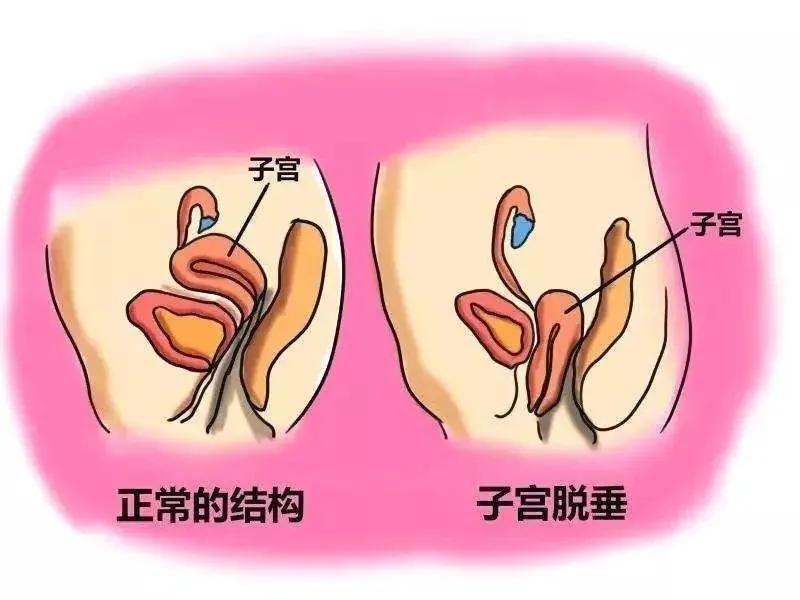 有关子宫脱垂的治疗，子宫脱垂的症状