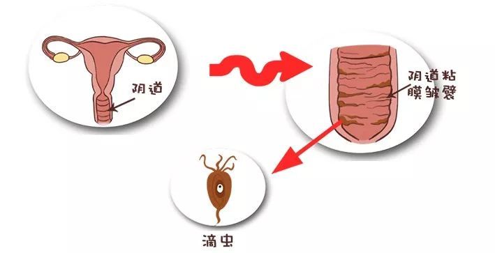 女性各类常见阴道炎的防和治，宅在家里应知道