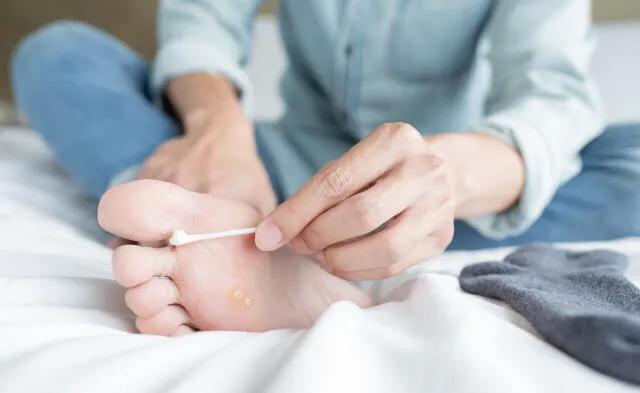 医生教你怎么治理香港脚（脚气、足癣）