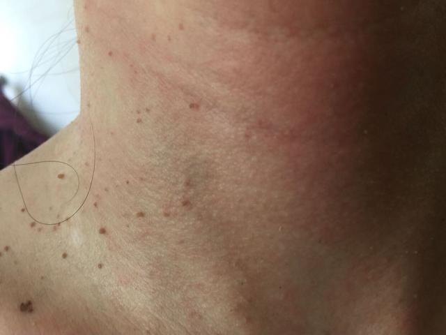 脖子、腋窝、大腿根出现的“小肉粒”是什么？或与你想的不一样