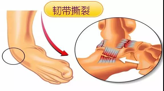 崴脚了不应该忽视！要怎样处理呢？