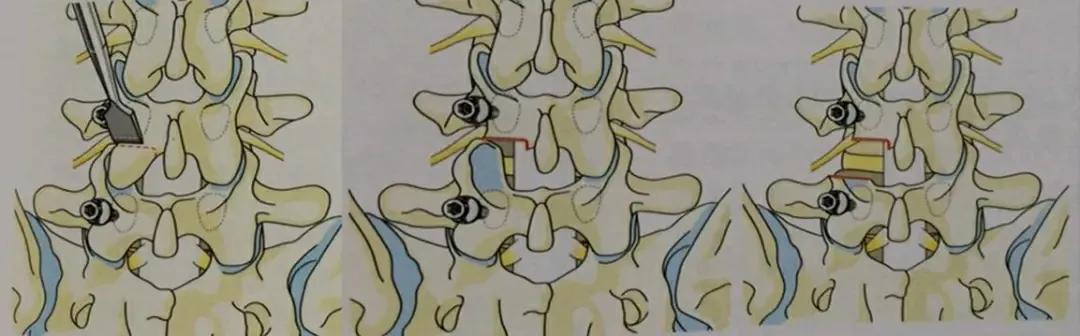 腰痛腿麻怎么办？是椎间盘突出了吗？