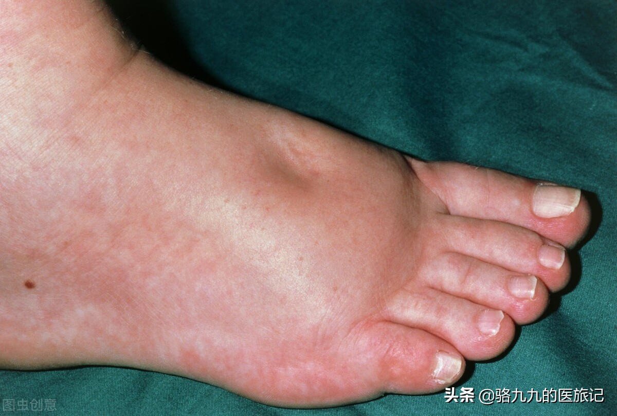 全面认识水肿,身体为啥肿起来了?听我一一道来