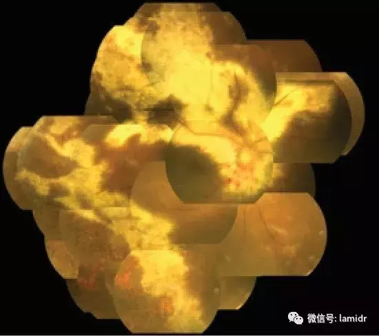 HIV感染,为什么出现眼部症状?