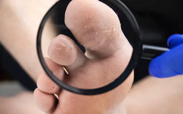 医生教你怎么治理香港脚（脚气、足癣）