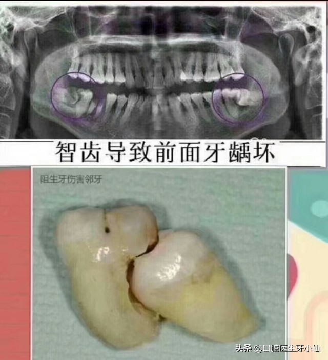 新冠疫情期间智齿疼痛的缓解方法