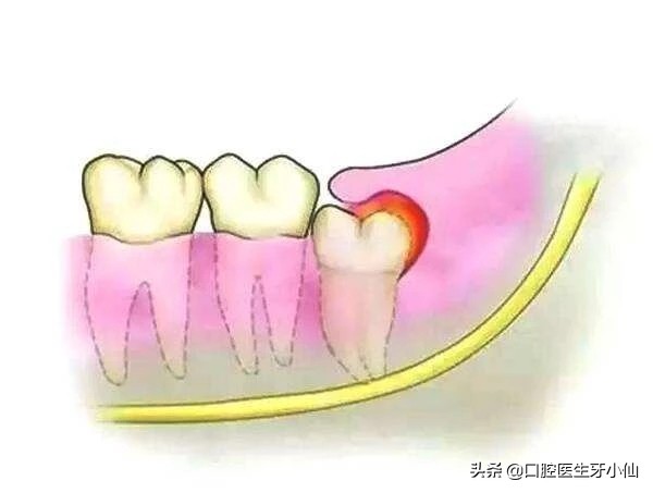 新冠疫情期间，智齿发炎疼痛，如何自我缓解？