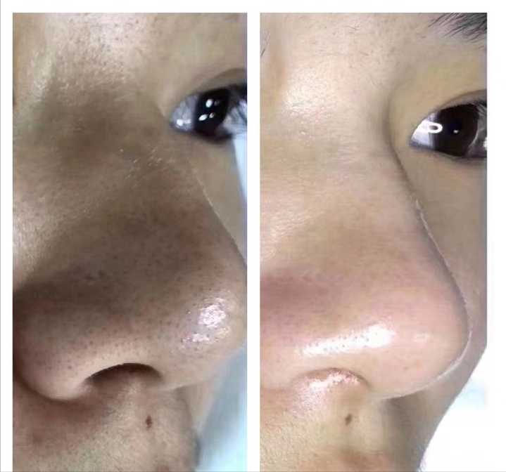 去黑头什么方法比较好?