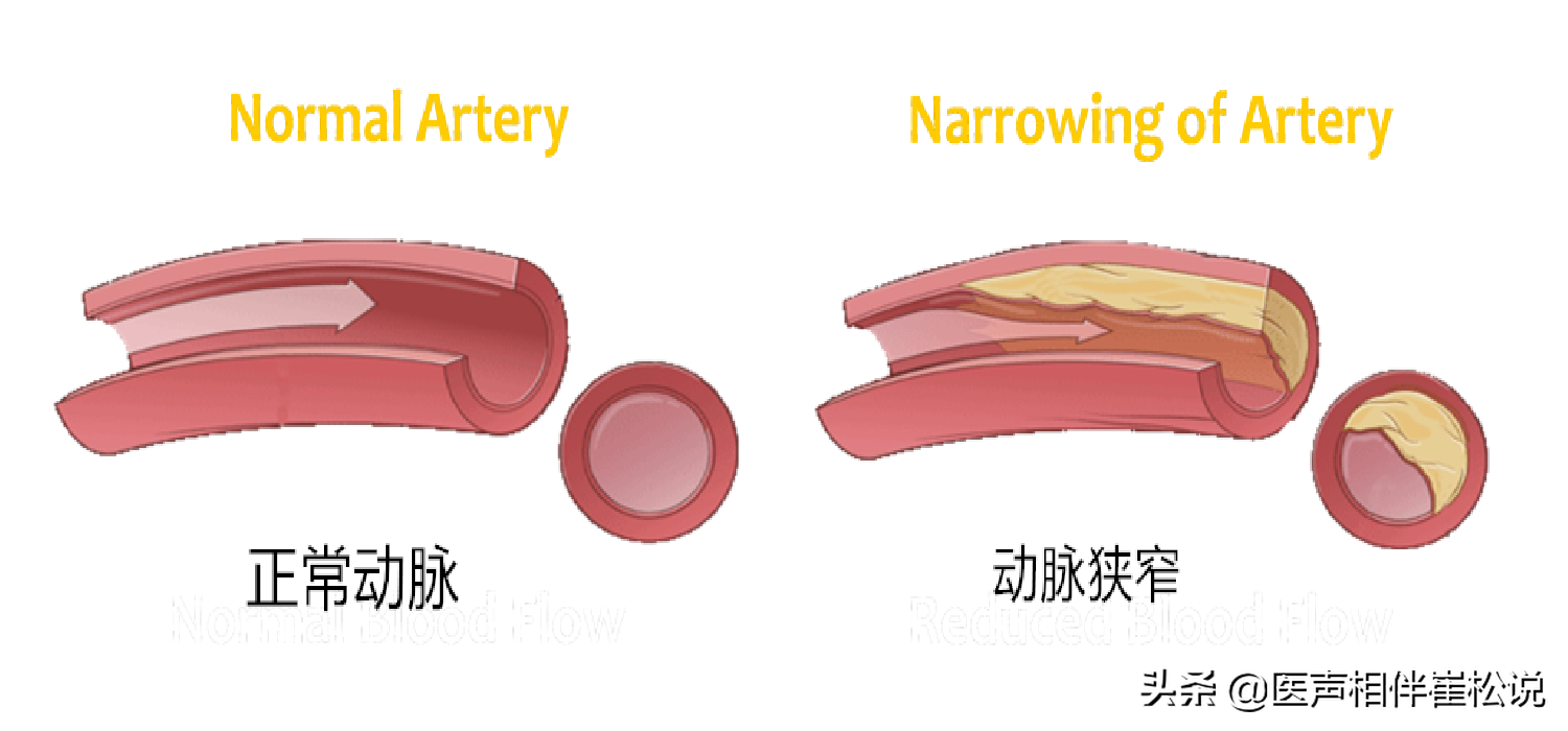 脑梗和腔梗是一回事儿吗？