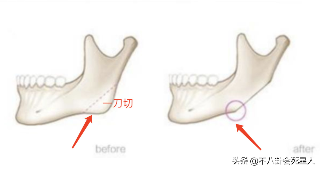 那些削骨的女星脸还好吗？后遗症一大堆，杨幂鞠婧祎都开始崩了