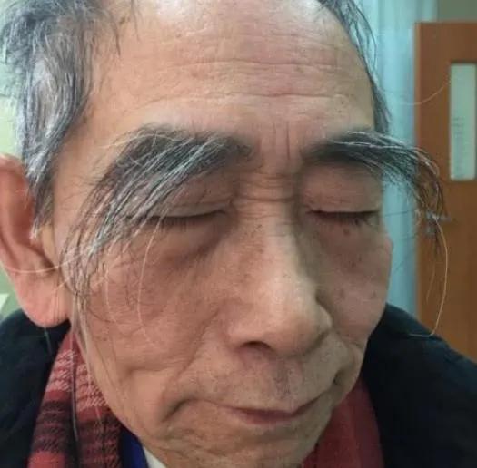 50岁后男性眉毛变长意味着长寿？医生直言：可能是某些肿瘤