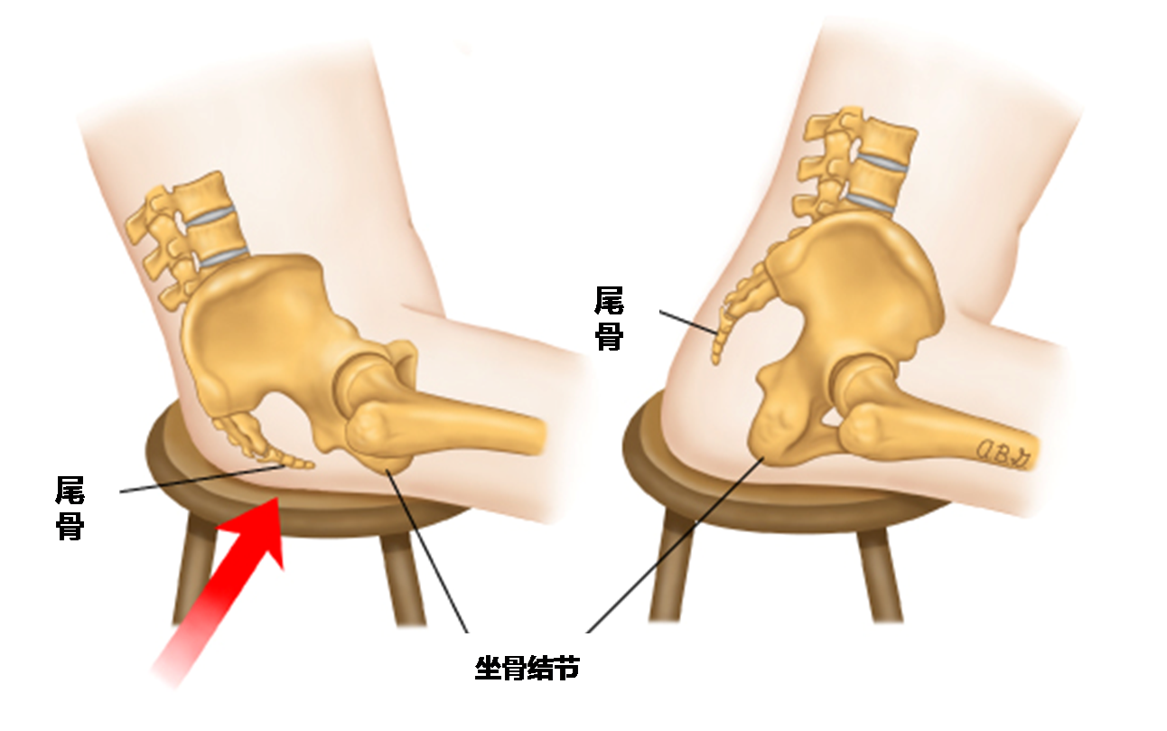 尾椎骨摔伤怎么养最佳「图文」-骁龙网