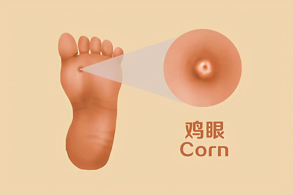 脚上长了***眼，有什么好方法能去除？***眼的原因有哪些？