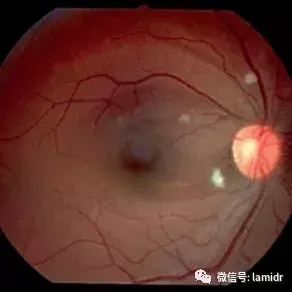 HIV感染,为什么出现眼部症状?