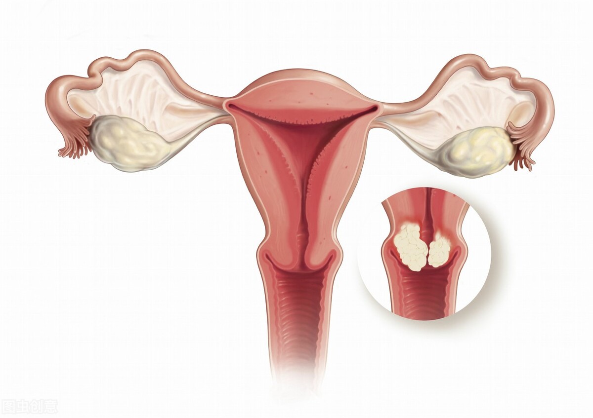 hpv58阳性可以打宫颈癌疫苗吗?医生朋友建议不打宫颈癌疫苗