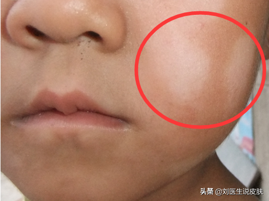 小孩脸上有白斑是啥病？医生：不是肚子“有蛔虫”，警惕这4种病