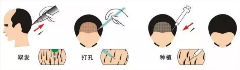脱发人士必看:拯救发量的N个办法,到底哪个最靠谱?