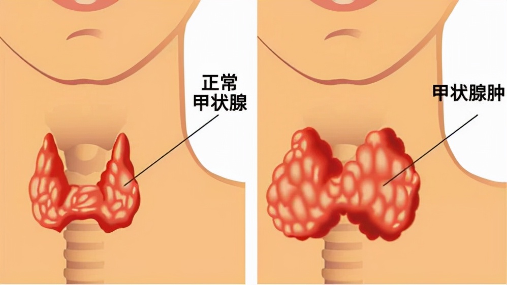 甲状腺结节会发生癌变吗？在饮食方面应该注意哪些？