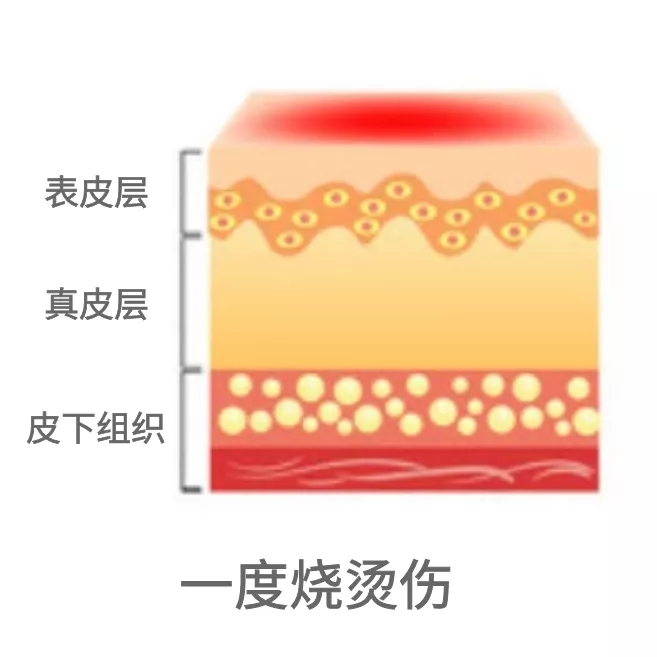 烧伤、烫伤后怎么办?五字诀帮你渡难关