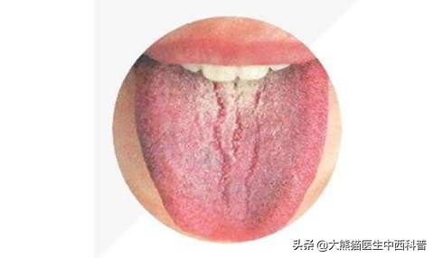 你舌头上有裂纹吗？引起裂纹舌的原因有哪些？