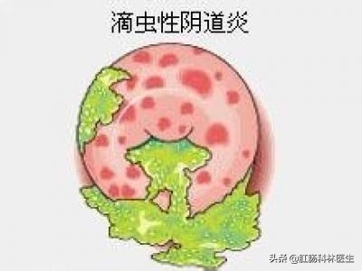 疫情之下女性阴道炎的自我护理