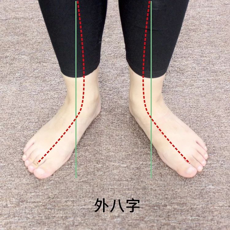 足脊健康知识小课堂(第三期) |  外八字篇