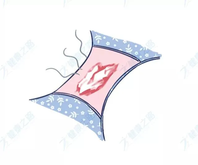 发黄、发臭、拉丝…出现6种白带异常，警惕阴道炎症