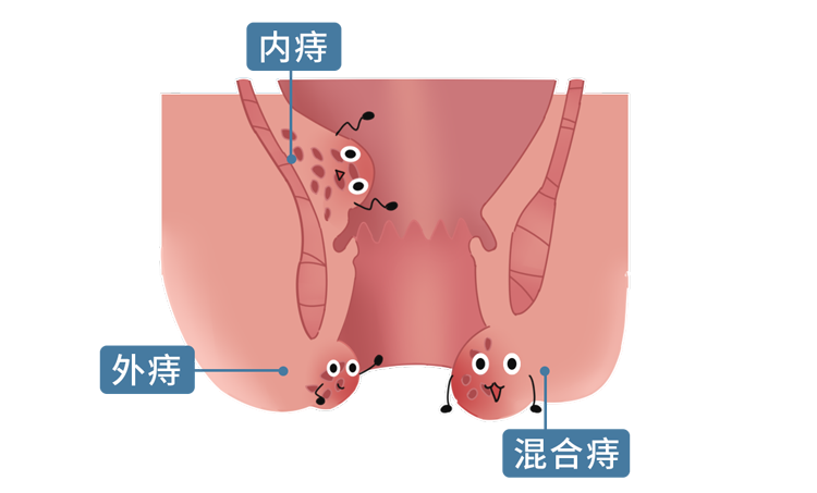解锁“提肛运动”，肛肠、前列腺、泌尿系统都会感谢你