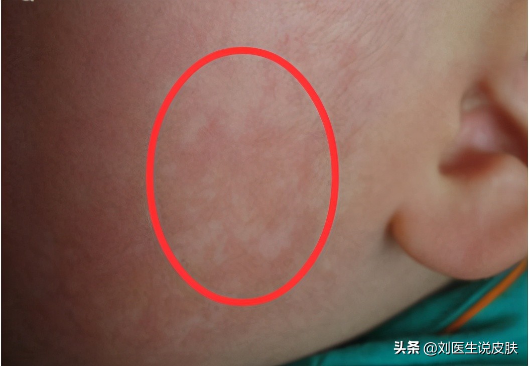 小孩脸上有白斑是啥病？医生：不是肚子“有蛔虫”，警惕这4种病