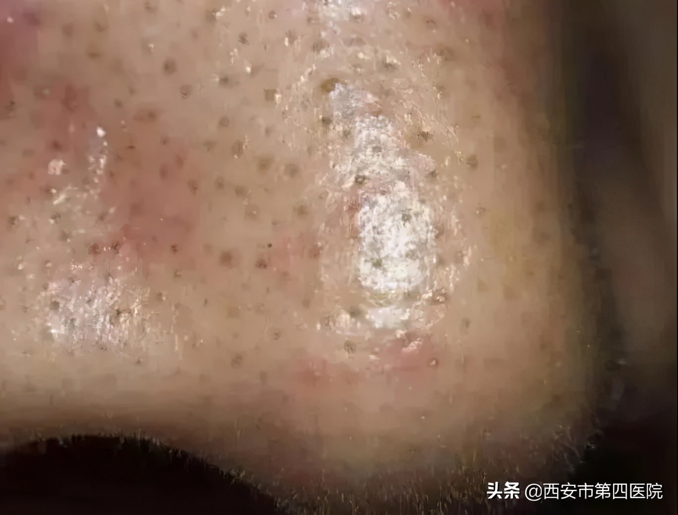 #健康中国行动2030#【变美秘籍】毛孔粗大怎么彻底解决？