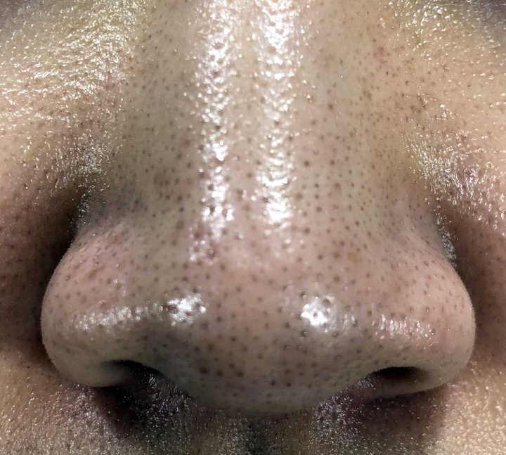 去黑头的最好方法简单又快捷的去黑头小妙招