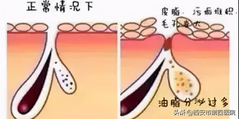 #健康中国行动2030#【变美秘籍】毛孔粗大怎么彻底解决？