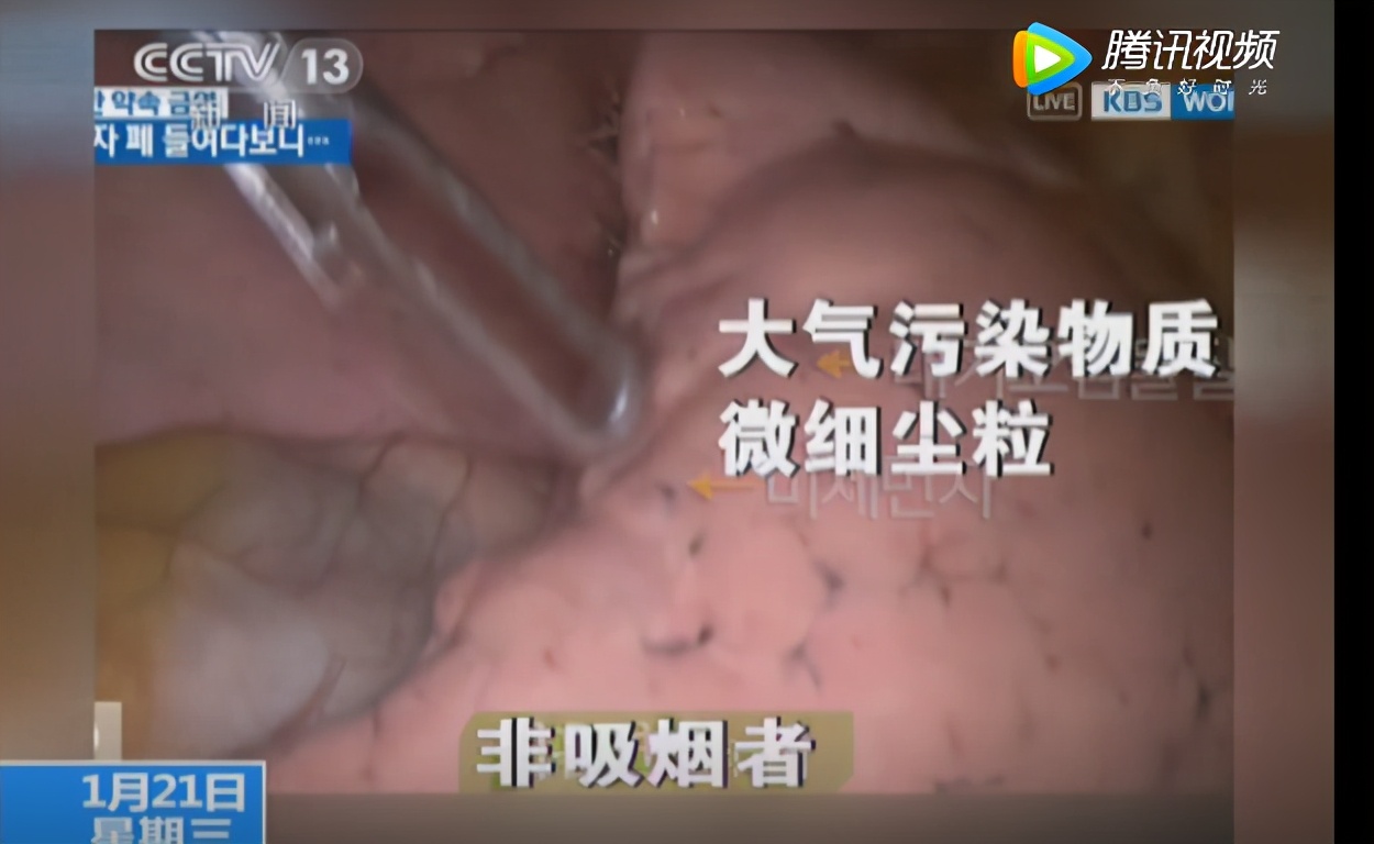 内窥镜视角揭秘：吸烟如何损伤肺部
