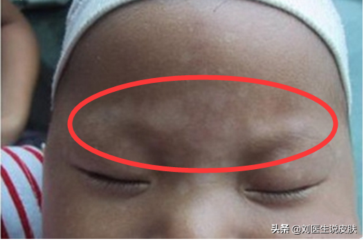 小孩脸上有白斑是啥病？医生：不是肚子“有蛔虫”，警惕这4种病