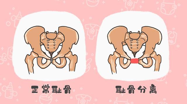孕期为啥会耻骨痛、疼在哪里?原来有两块骨头在分离,5招可缓解