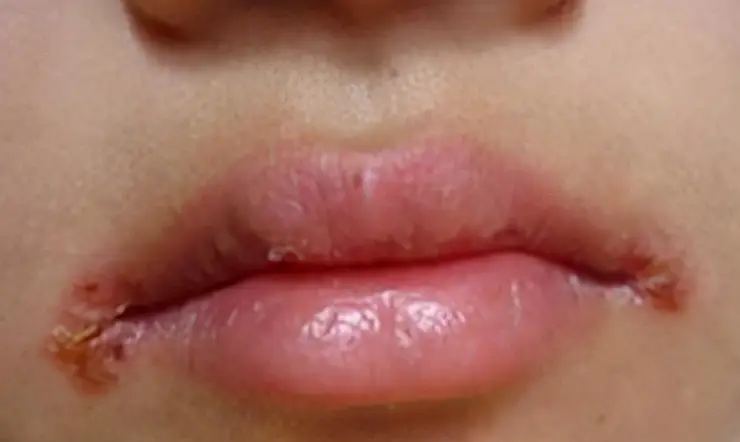 嘴角烂了怎么快速好（嘴角烂是上火的表现吗）