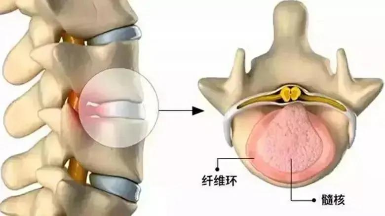 腰痛腿麻怎么办？是椎间盘突出了吗？