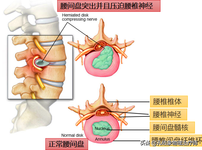 腰椎间盘突出压迫神经了，屁股和腿疼，有什么好的治疗方法？