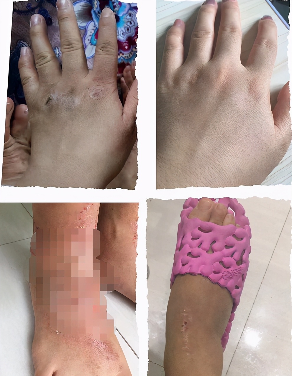 疱疹与湿疹的快速治疗方法指南