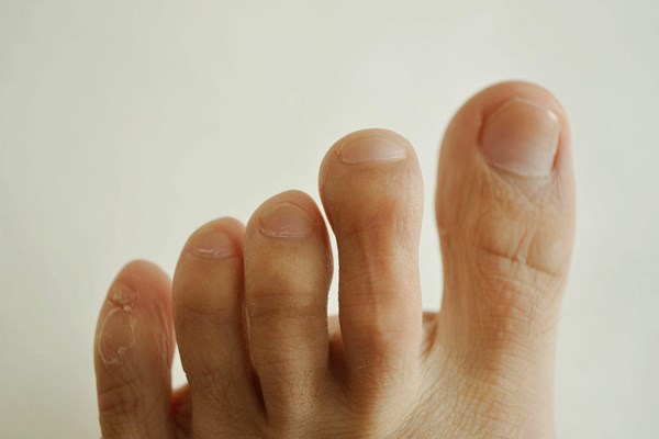 脚指甲长到肉里面，一走路就疼？自己在家如何应对？