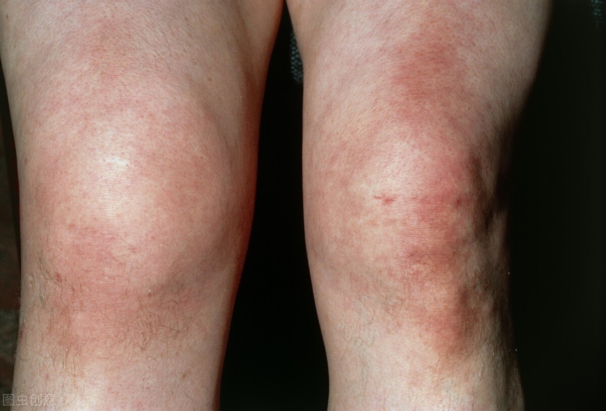 膝盖积液症状有哪些图片