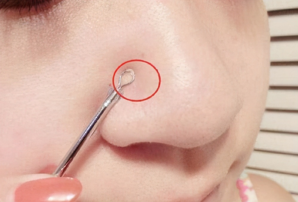 2,针清或者细胞夹,比手挤好一点,也是暴力去黑头,拔出萝卜带出泥的