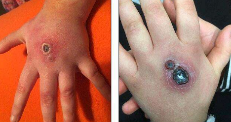 被马蜂蛰了怎么办小妙招马蜂蛰到了怎么办怎么处理