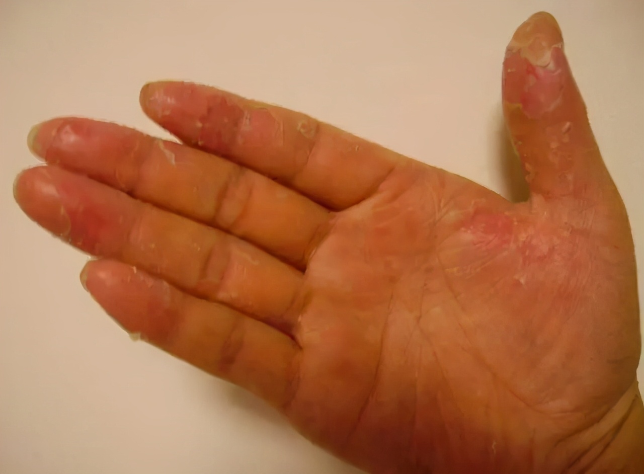 冬季双手脱皮，可能是这5种原因，注意其中一种会传染